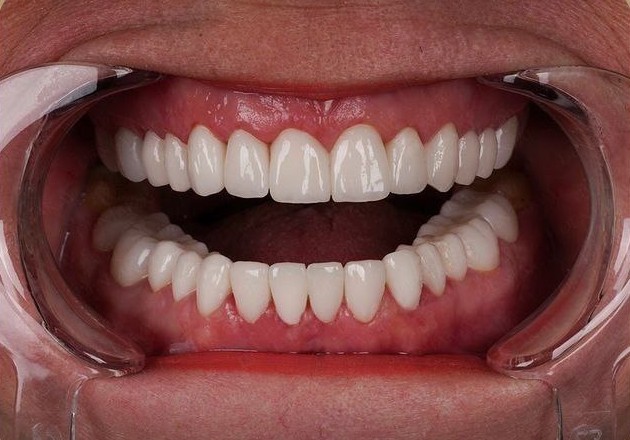 Illustrative balanced tooth edges after conservative bonding