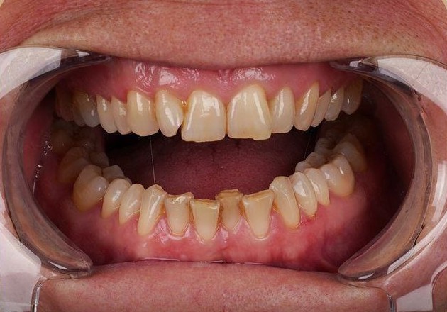 Illustrative uneven tooth edges before conservative bonding